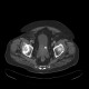 Urocystolithiasis, stone in urinary bladder: CT - Computed tomography